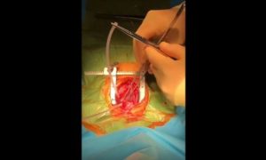 Yenidoğan Kalp Çalışırken Pulmoner Kapak Açılma Ameliyatı